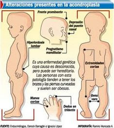 Fuente: https://ar.pinterest.com/julioescobarus/niños-acondroplasia/